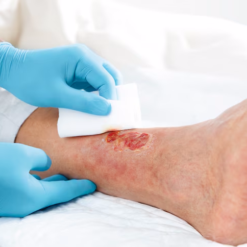 Leukoplast® Compress Cotton Gauze - 5cm x 5cm - BSN