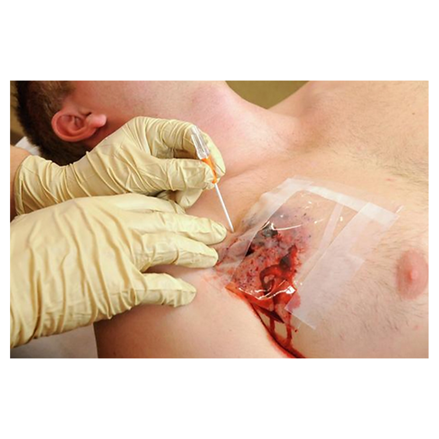 TPAK Chest Decompression Needle - 14 Gauge x 3.25" - TyTek Medical