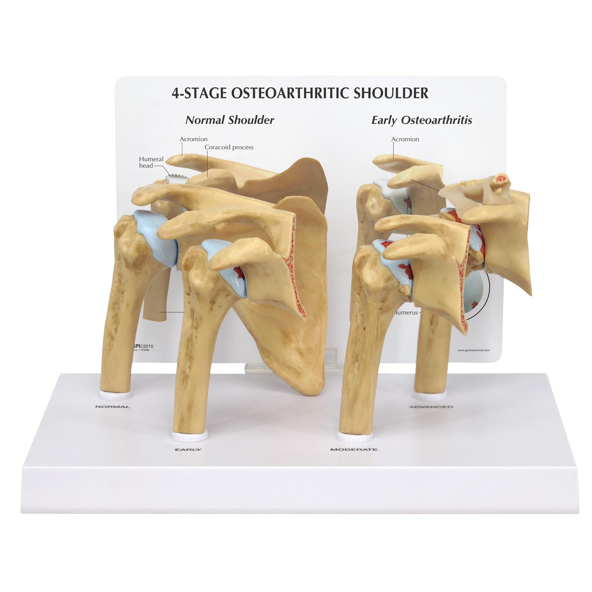 4 Stage Osteoarthritis (OA) Shoulder Model - 3B Scientific