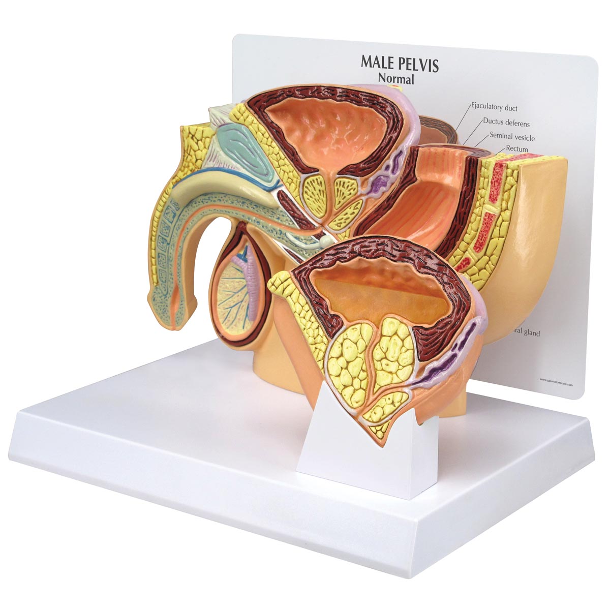 Male Pelvis BPH Model - 3B Scientific