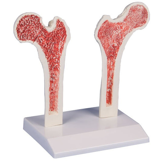 Osteoporosis Femur