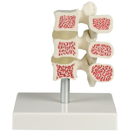 Osteoporosis Vertebrae Model - 3 Vertebrae -