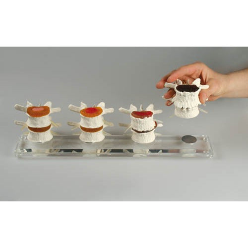 Stages of Disc Degeneration Model