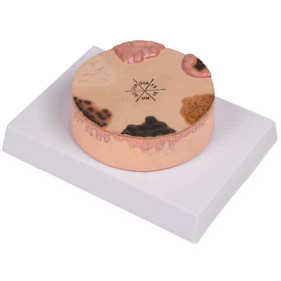 Skin Cancer Model - Erler Zimmer