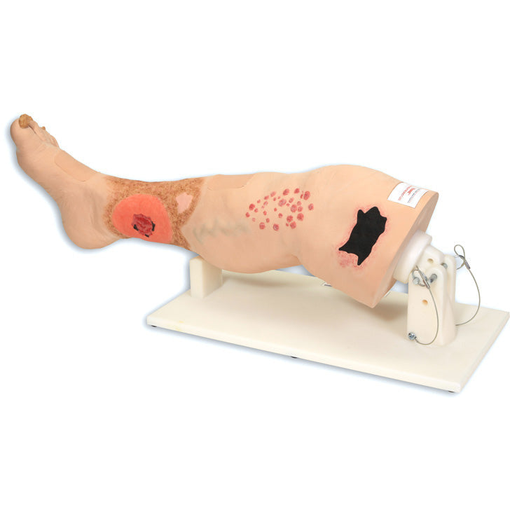 Vinnie Venous Insufficiency Leg - Erler Zimmer