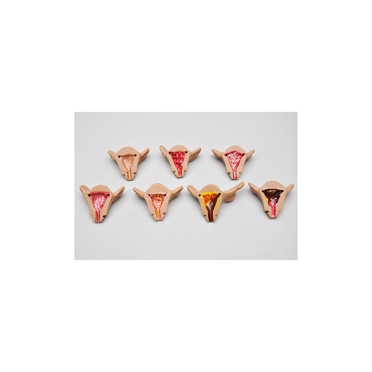 7 Uteri - Normal and with Internal Pathologies for hysteroscopic viewing - 3B Scientific