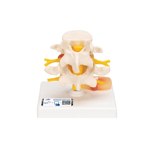Human Lumbar Spinal Column with Prolapsed Intervertebral Disc - 3B Scientific