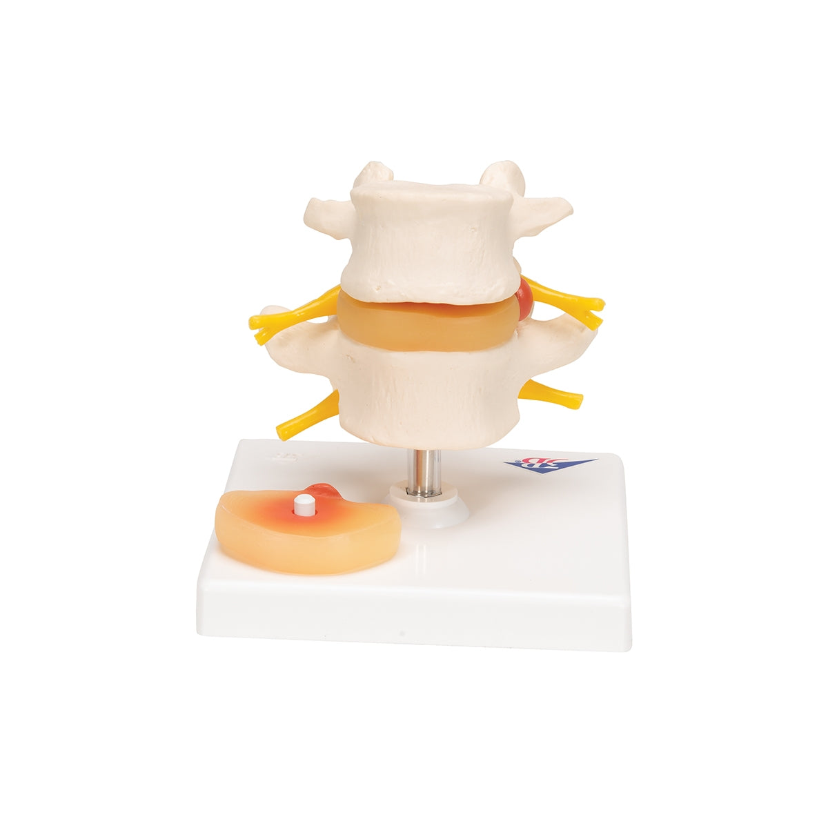 Human Lumbar Spinal Column with Prolapsed Intervertebral Disc - 3B Scientific