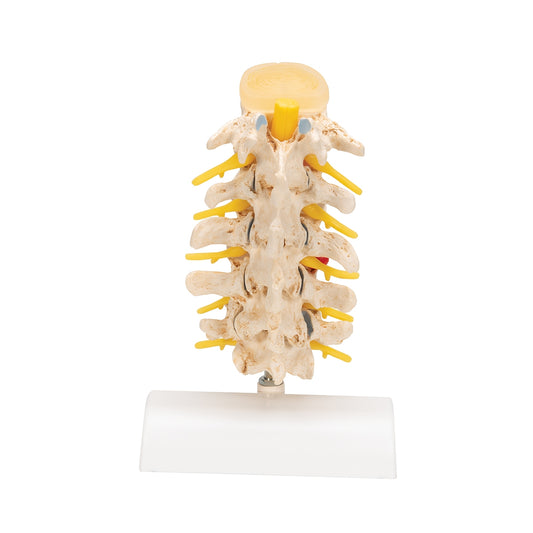 Stages of Disc Prolapse and Vertebral Degeneration - 3B Scientific