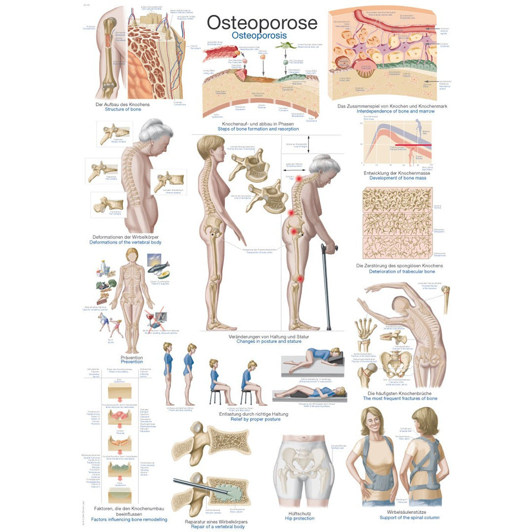 Osteoporosis - Poster