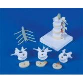 Lumbar Vertebrae With Prolapsed Intervertebral Discs