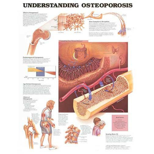 Poster: Understanding Osteoporosis