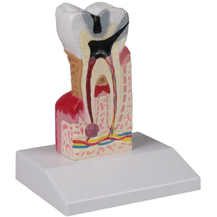 Dental Caries Model - 10 Times Life-Size