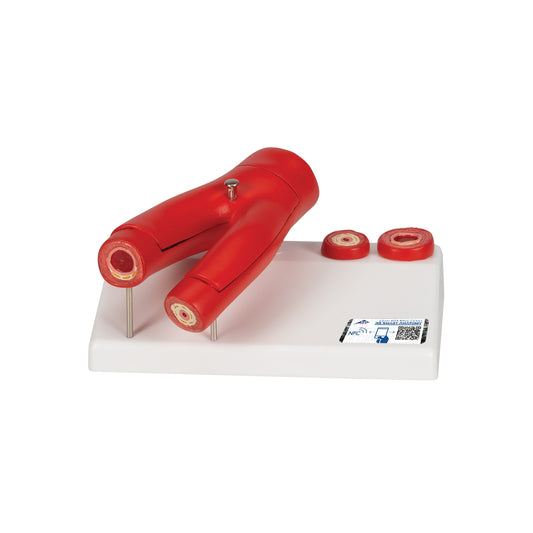 Arteriosclerosis Model, with Cross Section of Artery, 2 part - 3B Scientific