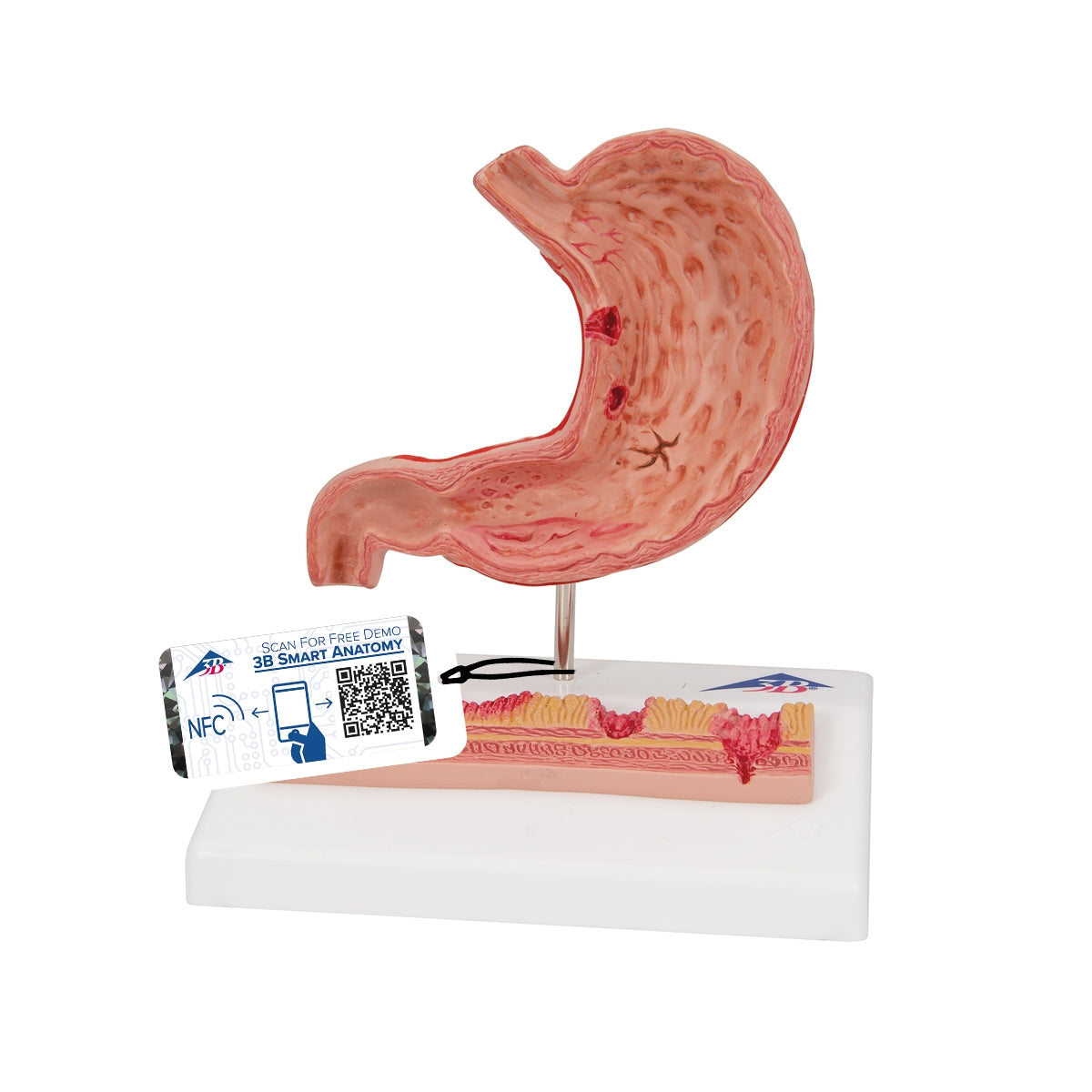Human Stomach Section Model with Ulcers - 3B Scientific