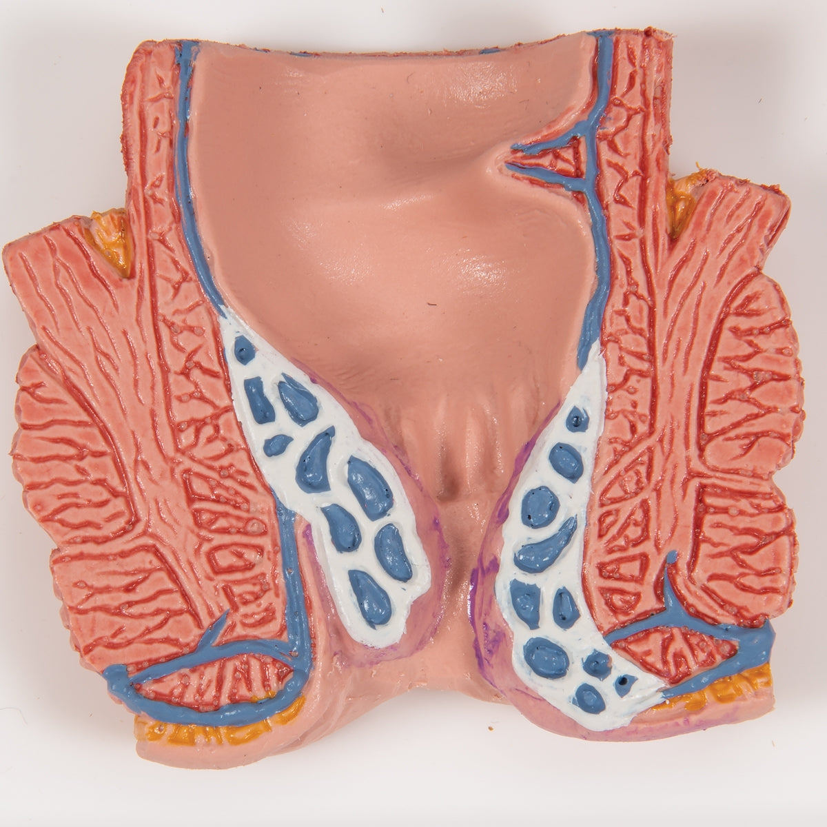 Hemorrhoid Model - 3B Scientific