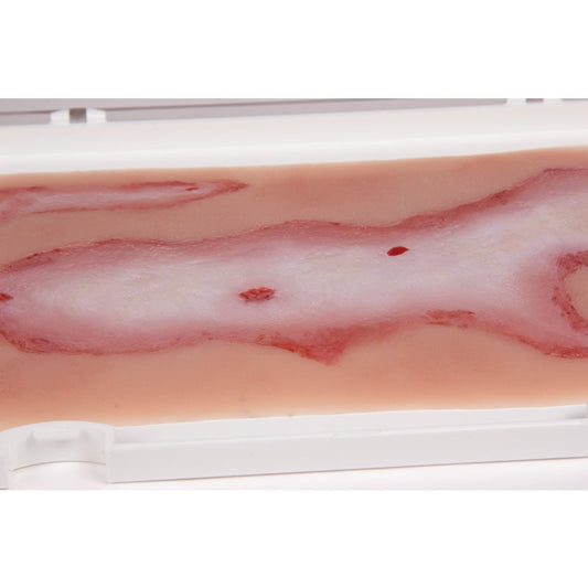 Wound Moulage Scalding - Large - Erler Zimmer