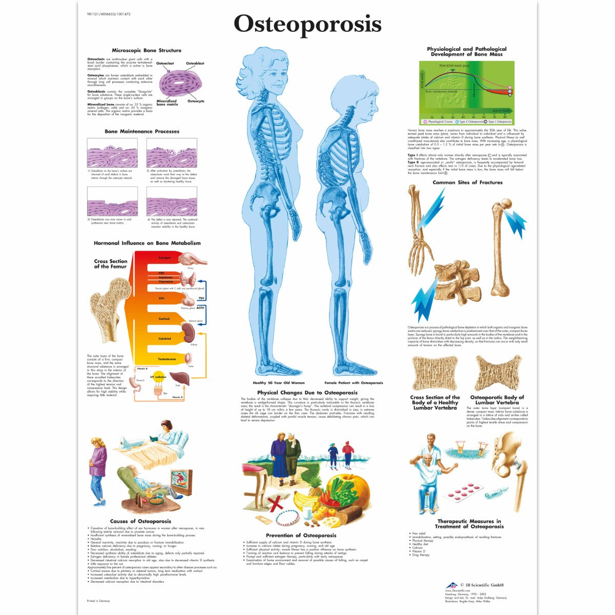 Osteoporosis Chart - 3B Scientific