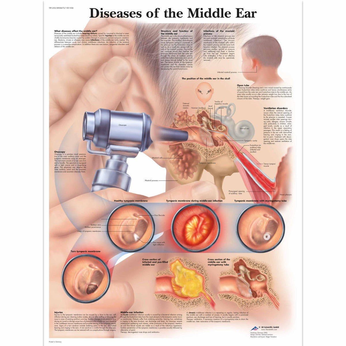 Diseases of the Middle Ear Chart - 3B Scientific