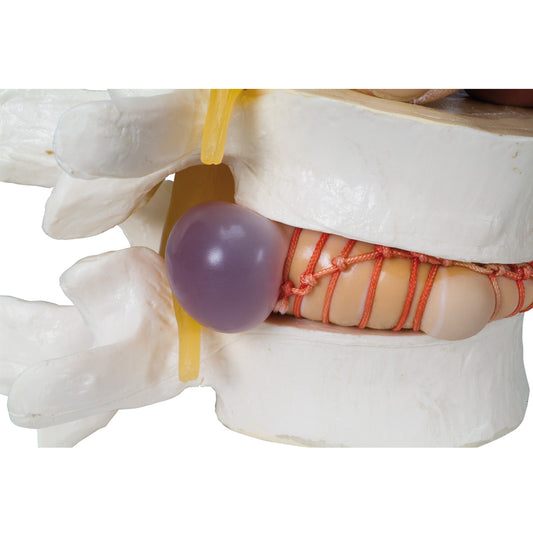 Herniated Disc Simulator - 3B Scientific