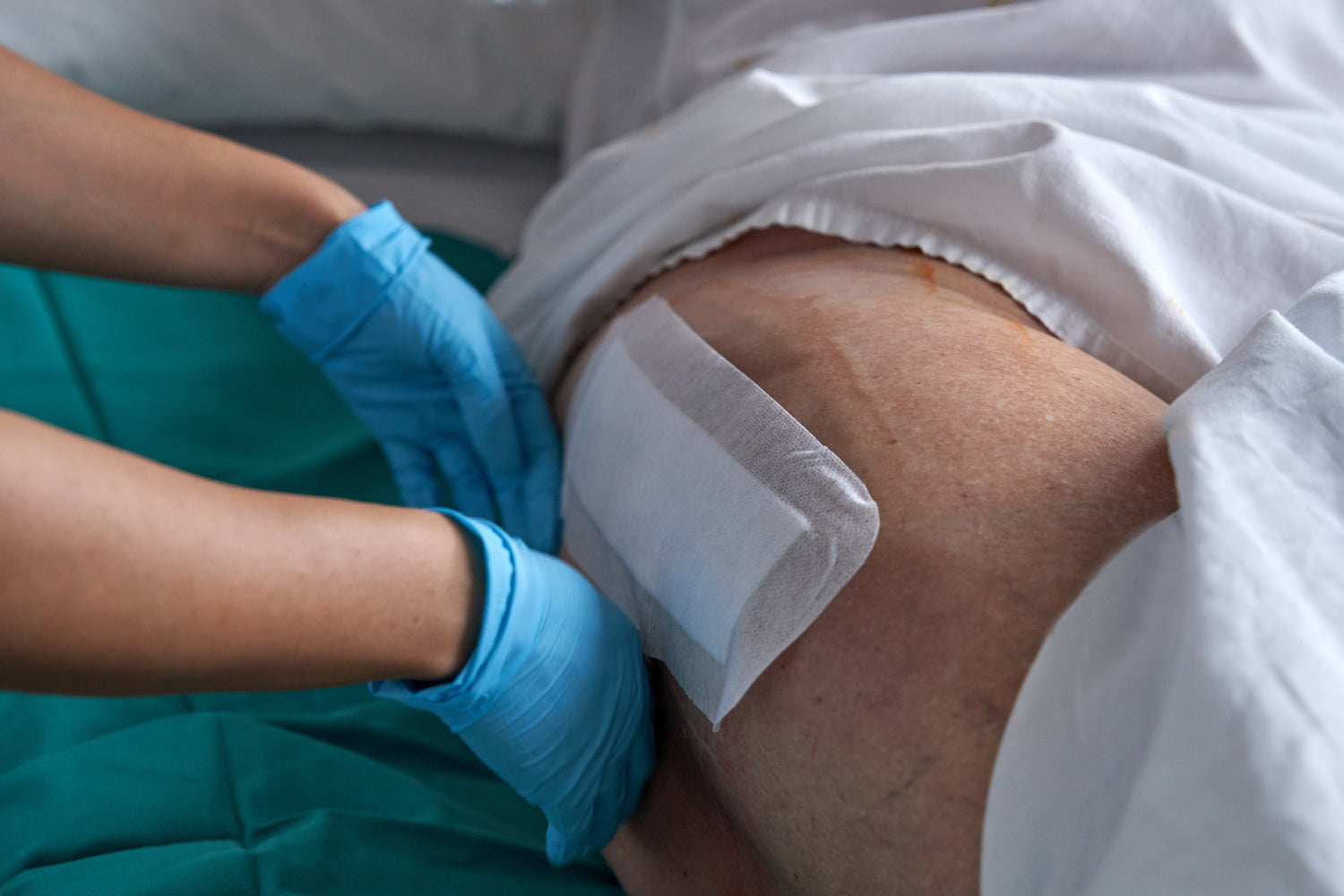 Hydrocolloid Dressings