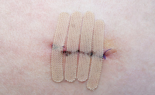 Wound Closure & Skin Adhesive Strips