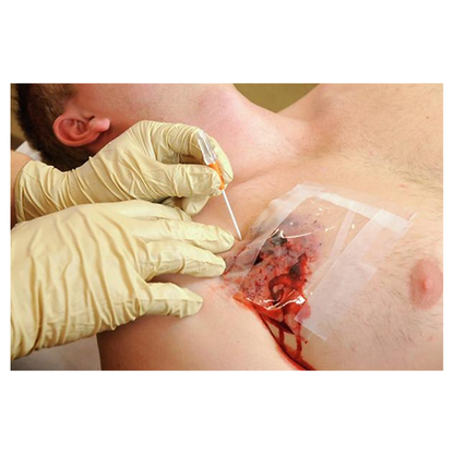 TPAK Chest Decompression Needle - 14 Gauge x 3.25" - TyTek Medical