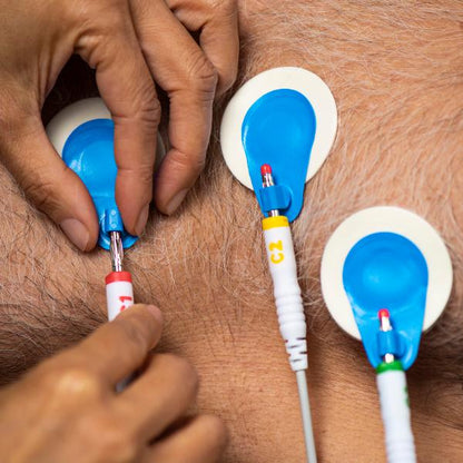 Ambu BlueSensor R ECG Electrodes - Pack of 25