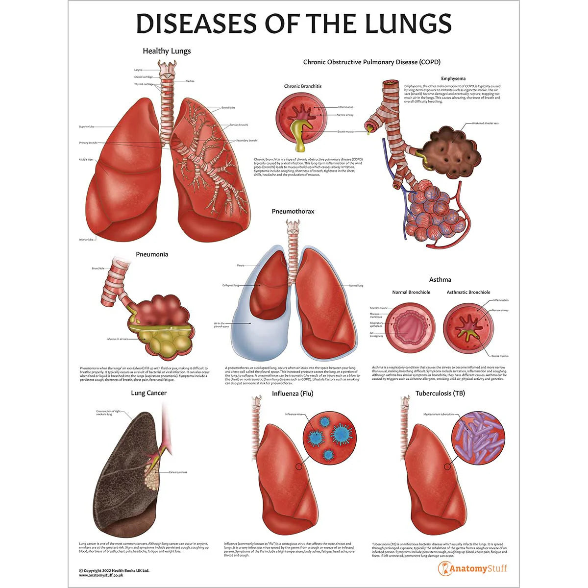 Lung Anatomy & Pathology Collection - 