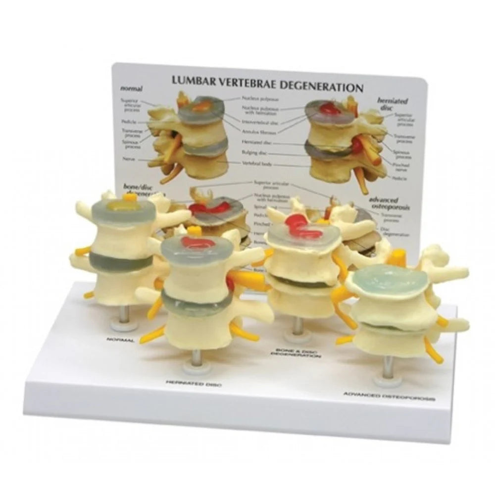 Lumbar Pathologies Spine Anatomy & Pathology Collection – Medisave UK