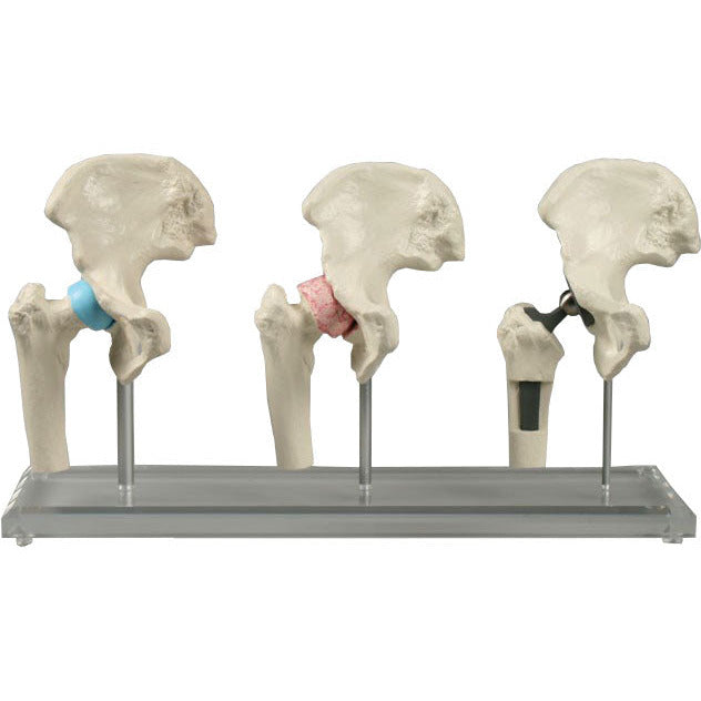 Hip Implant Model
