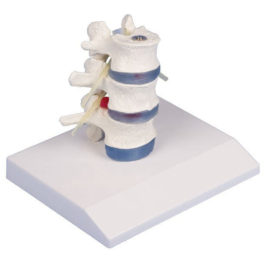 Lumbar Vertebrae with Prolapsed Inter Vertebral Discs with Stand