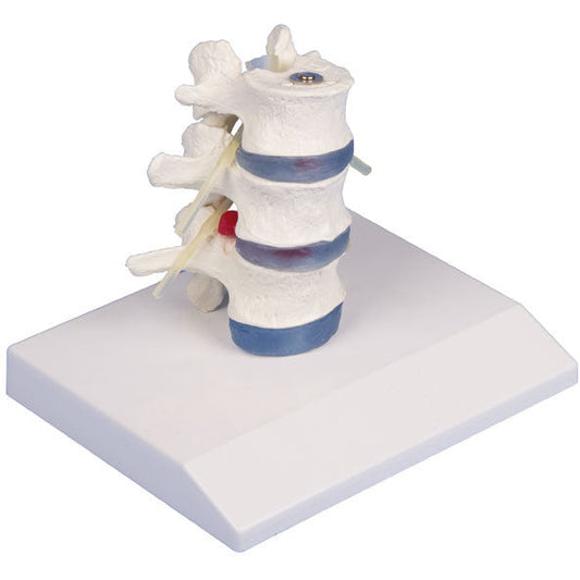 Lumbar Vertebrae with Prolapsed Inter Vertebral Discs with Stand