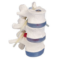 Lumbar Vertebrae with Prolapsed Inter-Vertebral Discs - Erler Zimmer