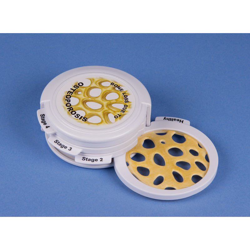 Osteoporosis Stages - Disc Model - Erler Zimmer