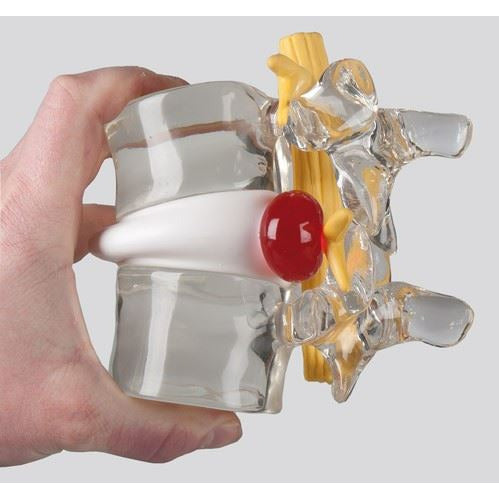 Erler Zimmer Herniated Disc Simulator