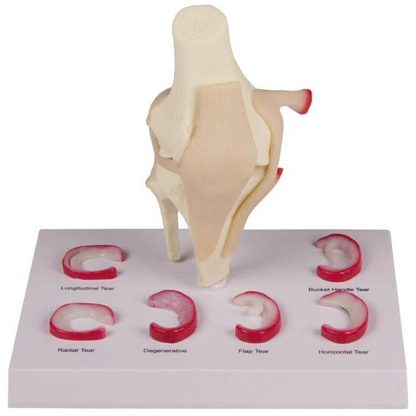 Knee Model with Meniscus Tears