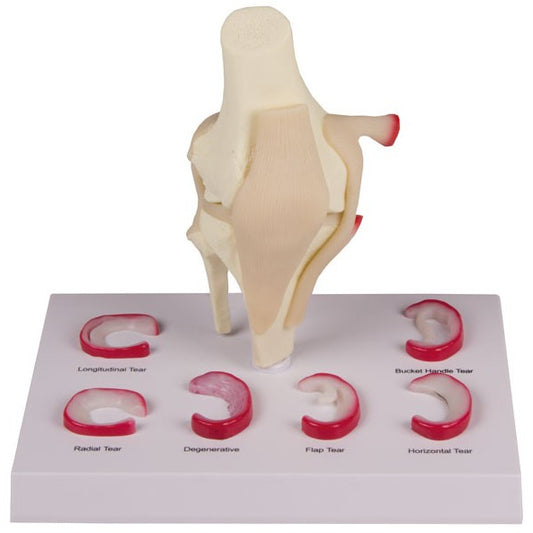Knee Model with Meniscus Tears
