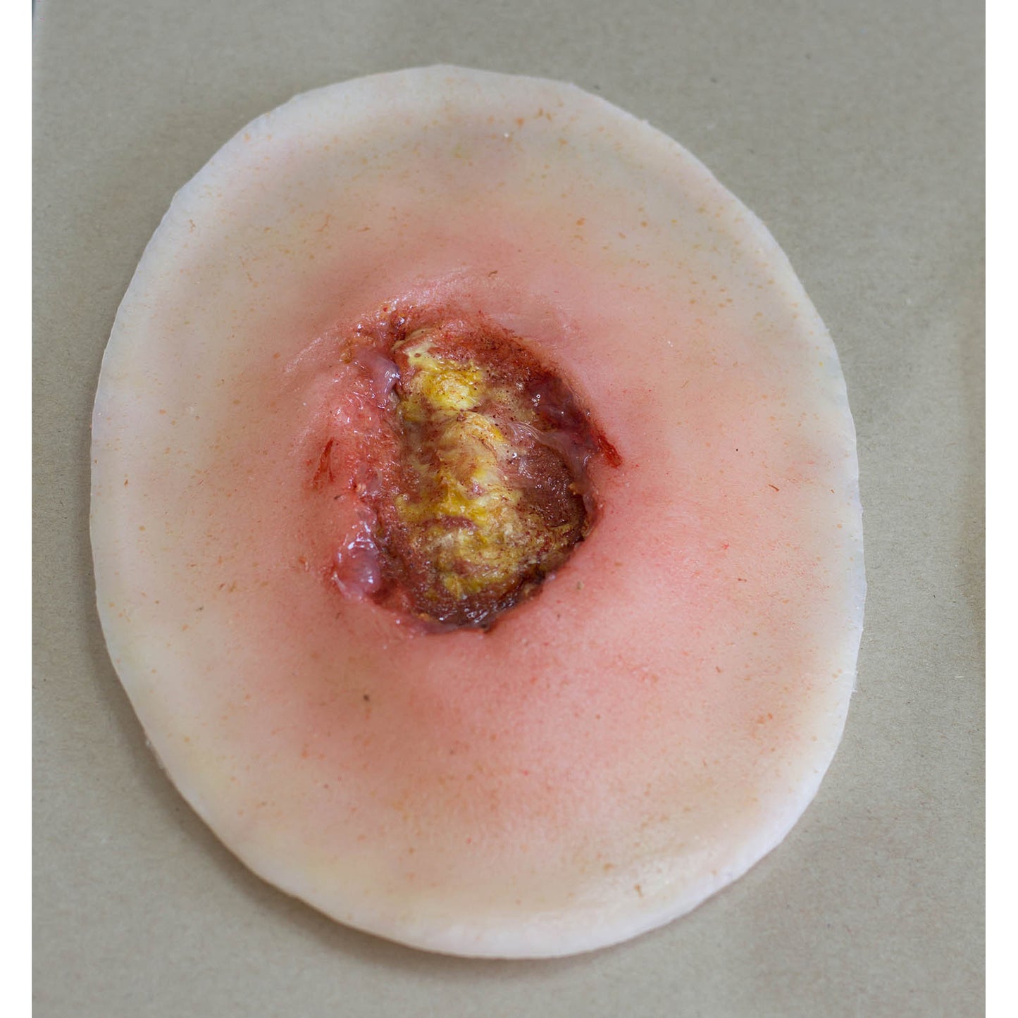 Surgical Wound - stapled - slightly Inflamed - Small - Erler Zimmer