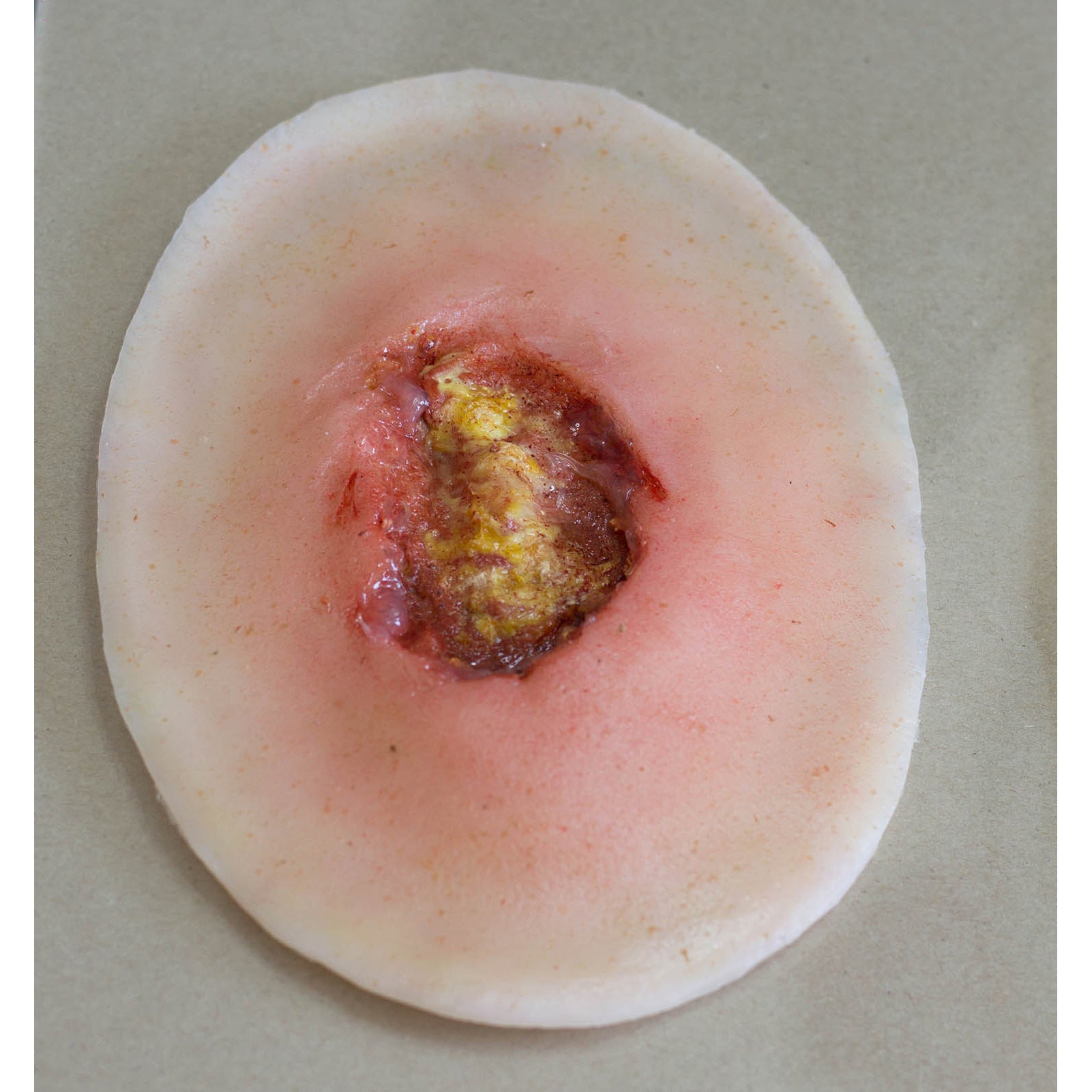 Surgical Wound - stapled - slightly Inflamed - Small - Erler Zimmer
