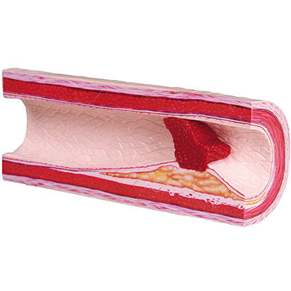 Atherothrombosis Model with Removable Thrombus - Erler Zimmer