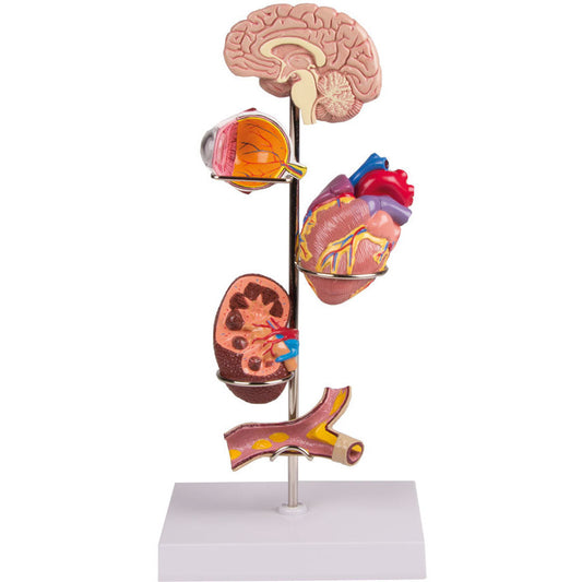 Hypertension Model Set - Erler Zimmer