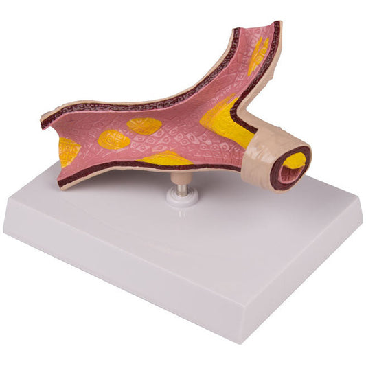 Arteriosclerosis Model - 1-Part - Erler Zimmer