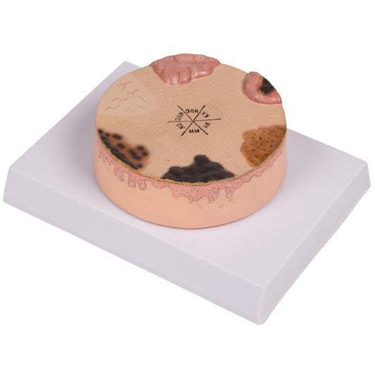 Skin Cancer Model - Erler Zimmer