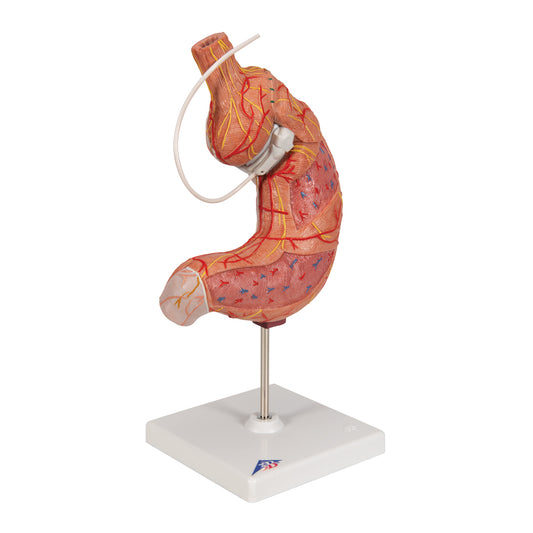 Human Stomach Model with Gastric Band, 2 part - 3B Scientific