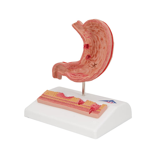 Human Stomach Section Model with Ulcers - 3B Scientific