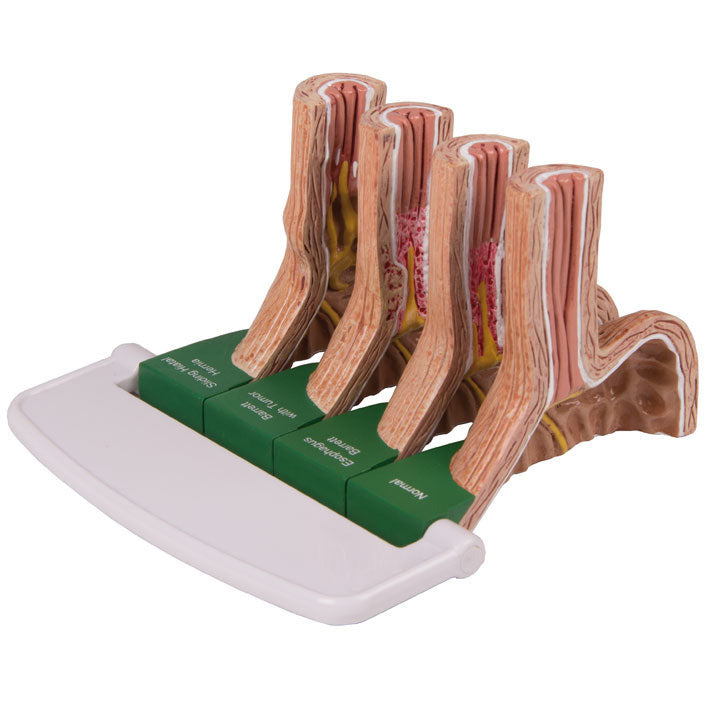 Gastroesophageal Reflux Disease - Erler Zimmer