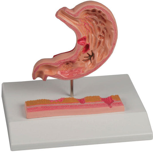 Stomach with Ulcers - Erler Zimmer