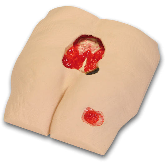 Stan Stage IV Pressure Ulcer Model - Erler Zimmer