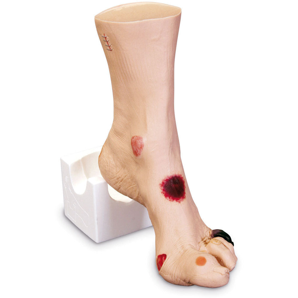 Wound Foot “Wilma”